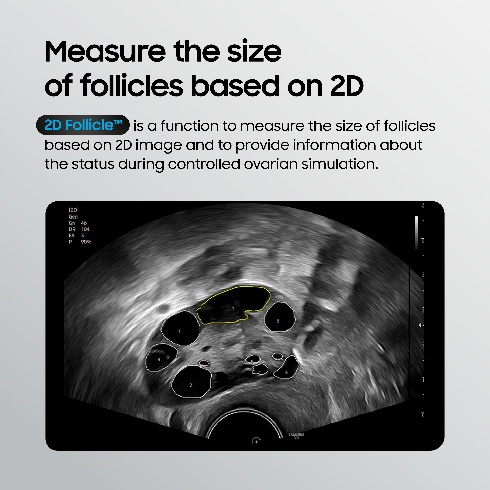 2D Follicle measuring follicle size