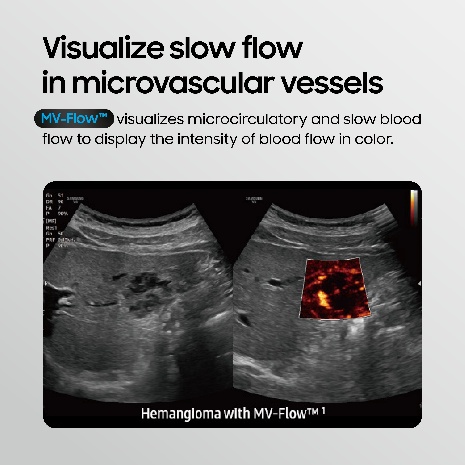MV-Flow visualizing slow flow in microvascular vessels