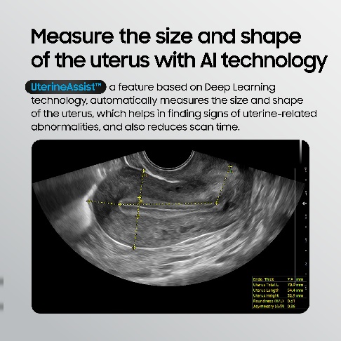 UterineAssist measuring uterus size and shape