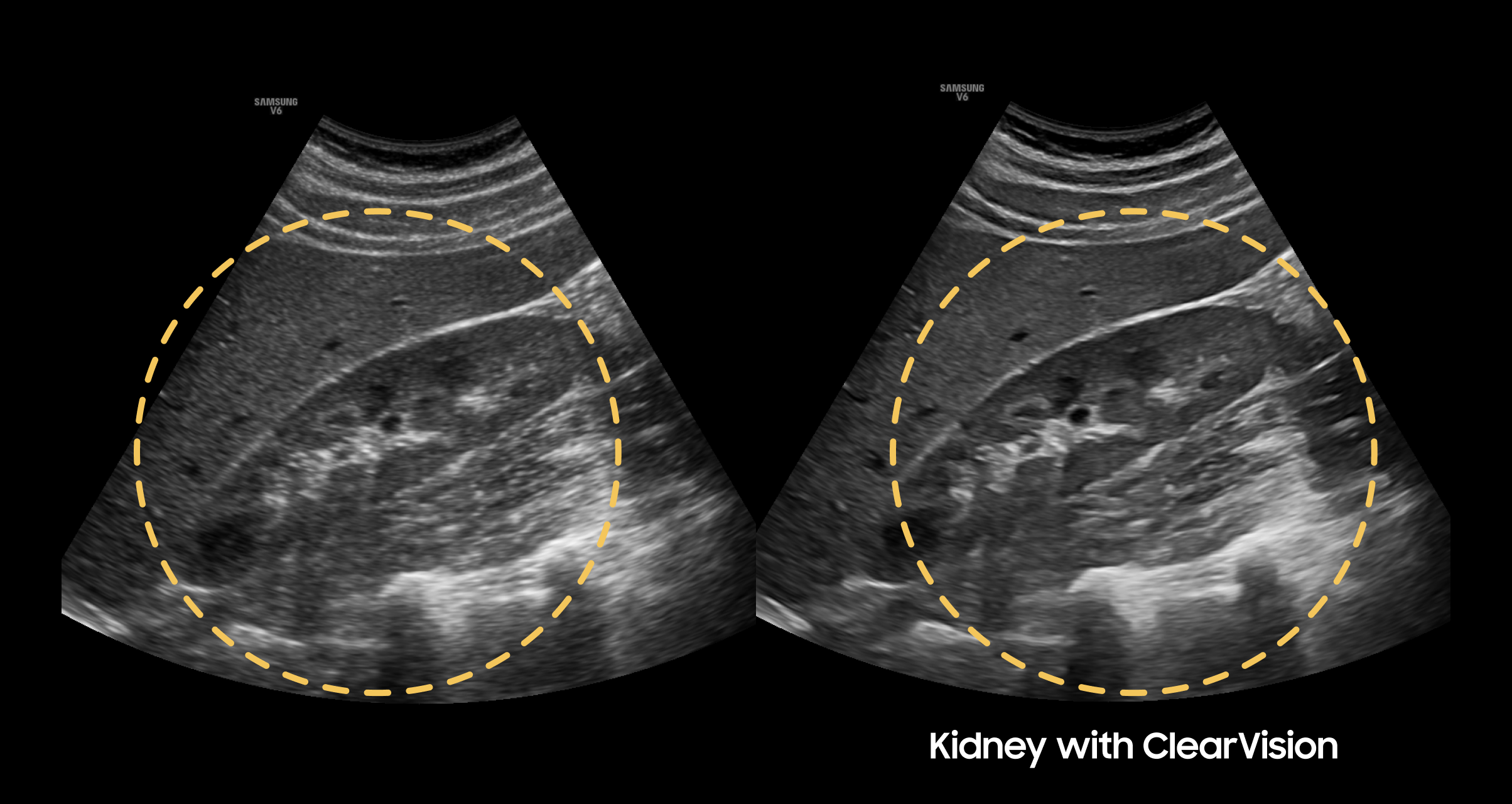 Side-by-side kidney ultrasound images demonstrating ClearVision noise reduction